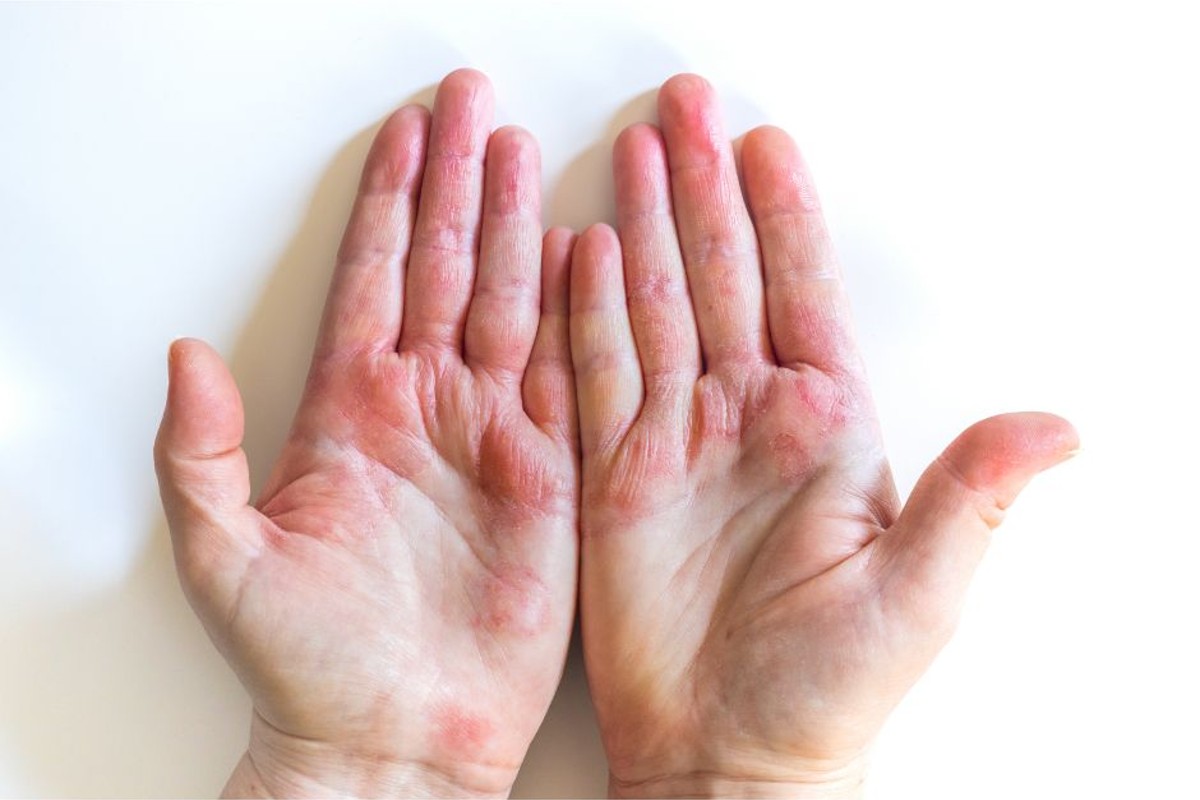 Photo of How to Treat Blisters on Your Hands